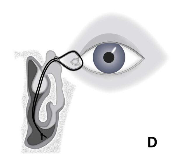 تسليك مجرى الدمع للكبار (Probing)